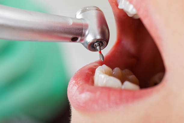 Best Emergency Root Canal Therapy in Tuscoosa, AL
